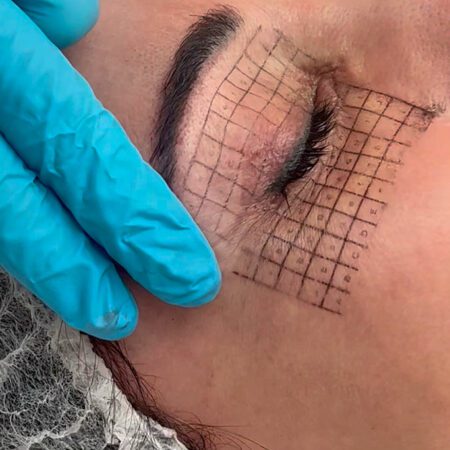 Thermage FLX contorno ojos